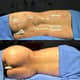 Slider image (9) Dr. Gabriel Sandoval - Plastic Surgeon in Mexico